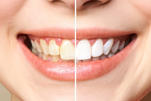 is teeth whitening safe for sensitive teeth