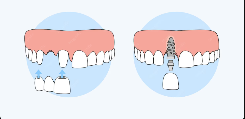 dental implants vs dental bridges